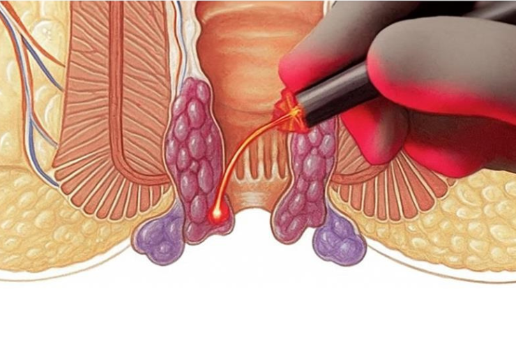 Laser Surgery for Piles, Fissure & Fistula